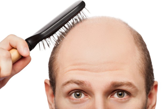 Alopecia: i rimedi naturali ed una corretta alimentazione