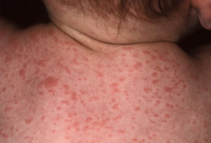 sesta-malattia-eruzioni-cutanee 2