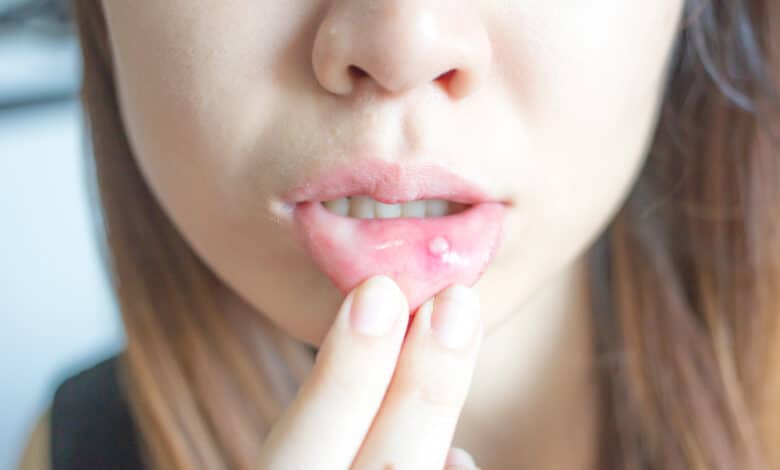 rimedi naturali contro le afte