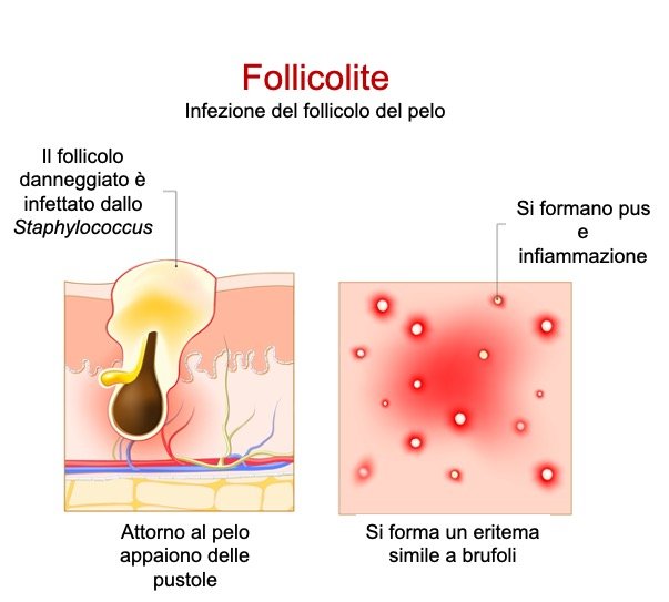 follicolite