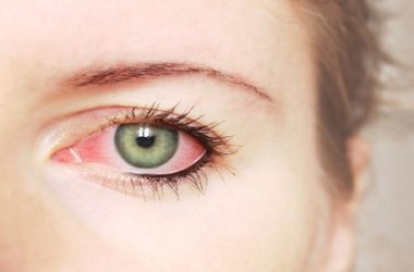 Congiuntivite: come curarla con rimedi naturali
