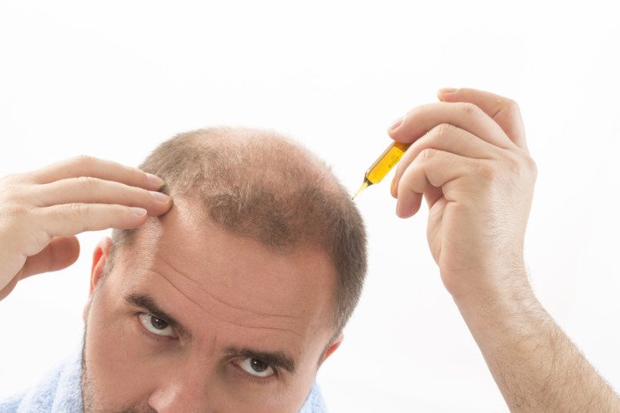Alopecia: i rimedi naturali ed una corretta alimentazione