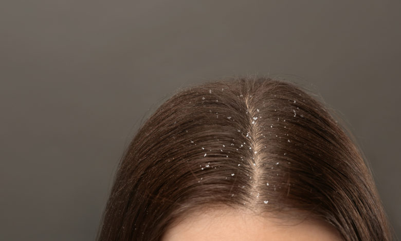 Rimedi naturali forfora