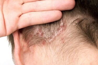 Lenire i disturbi della psoriasi in modo naturale: ecco i migliori sistemi