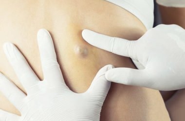Come prevenire e lenire di effetti delle cisti sebacee: la guida pratica