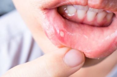 Stomatite nei bambini e non solo: quello che c’è da sapere