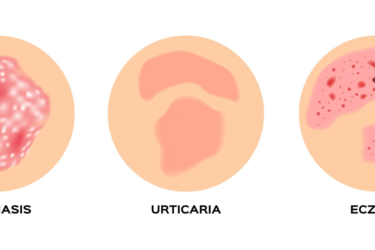 orticaria rimedi naturali