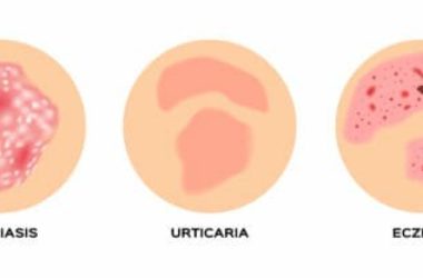Orticaria: come curarla e prevenirla in modo naturale