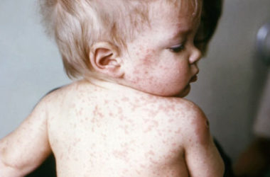 Sesta malattia: sintomi, durata e cure