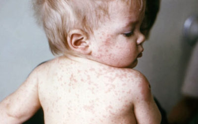 Sesta malattia: sintomi, durata e cure