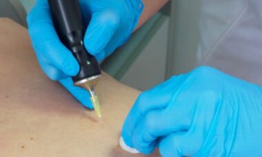 Carbossiterapia: cos’è e come funziona