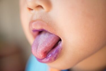 Bocca mano piedi, cos’è e come curarla