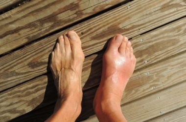 Gotta: sintomi, cure e rimedi naturali da conoscere