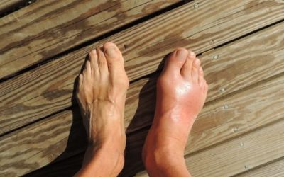 Gotta: sintomi, cure e rimedi naturali da conoscere