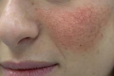 Esistono rimedi naturali per la dermatite seborroica: tutto quello che c’è da sapere