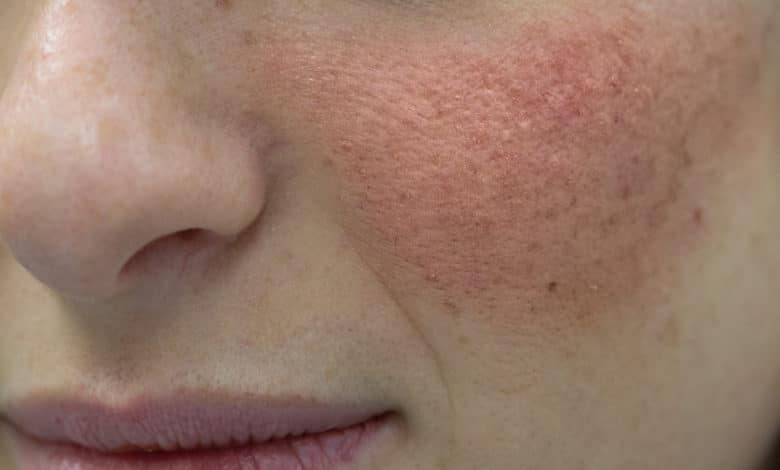 dermatite seborroica