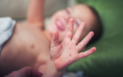 Bocca mano piedi, cos’è e come curarla