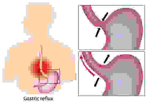 reflusso gastrico