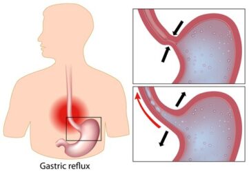 Reflusso gastrico sintomi e rimedi: cosa mangiare?