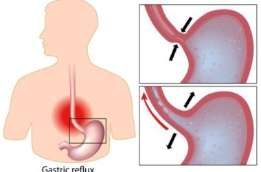 Reflusso gastrico sintomi e rimedi: cosa mangiare?