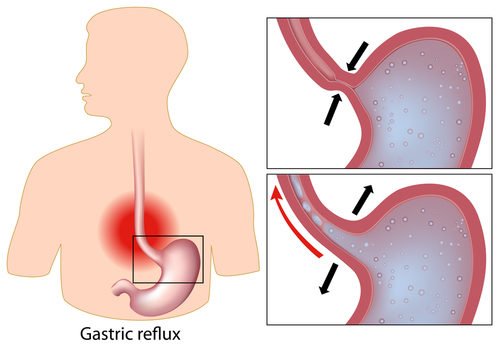 reflusso gastrico