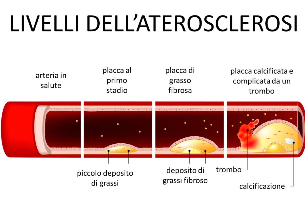 aterosclerosi