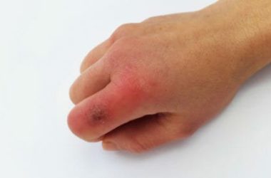Come prevenire e curare i geloni alle mani e ai piedi in modo naturale