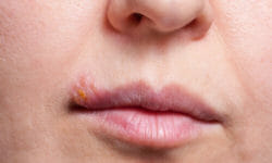 Scopriamo tutti i rimedi naturali per l’herpes labiale