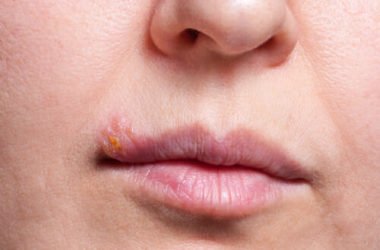 Scopriamo tutti i rimedi naturali per l’herpes labiale