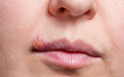 Scopriamo tutti i rimedi naturali per l’herpes labiale