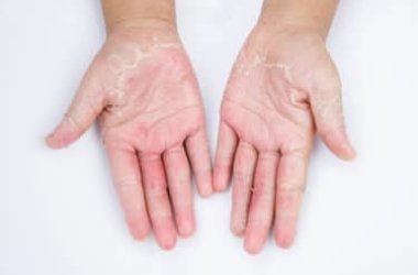 Dermatite da contatto: sintomi, cause e cure naturali