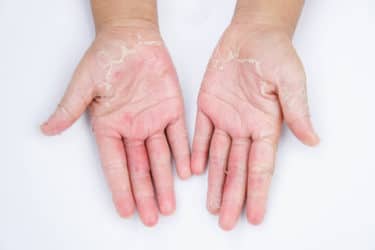 Dermatite da contatto: sintomi, cause e cure naturali
