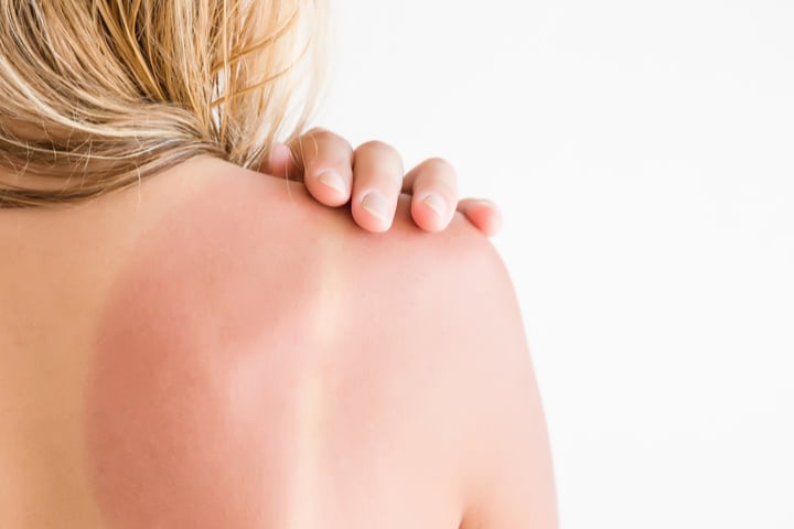  CURA NATURALE Dermatite Da Contatto Sintomi Cause E Cure Naturali