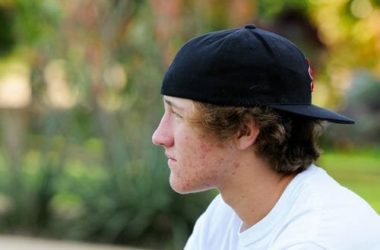 Acne giovanile rimedi naturali e prevenzione: 9 suggerimenti