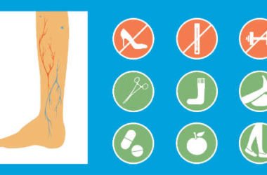 Flebite, conoscere questa infiammazione delle vene e curarla