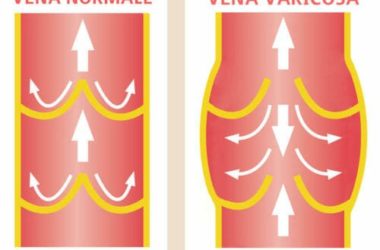 Flebite, conoscere questa infiammazione delle vene e curarla