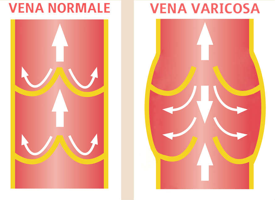 Flebite