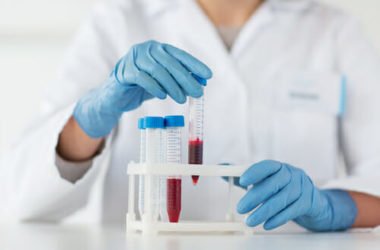 Ferro alto nel sangue: la dieta corretta per tornare in equilibrio