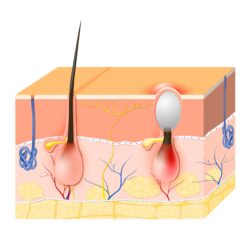 Cosa fare e cosa non fare in presenza di brufoli sottopelle: la guida pratica