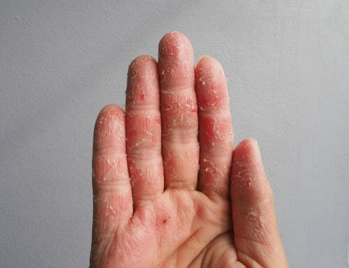 Disidrosi, cos’è e come si manifesta questo eczema e quali sono i rimedi naturali