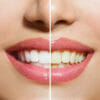 I segreti per sbiancare i denti con metodi naturali: quali sistemi (e alimenti) funzionano e quali no