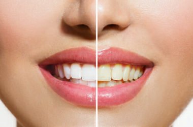 I segreti per sbiancare i denti con metodi naturali: quali sistemi (e alimenti) funzionano e quali no