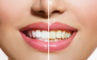 I segreti per sbiancare i denti con metodi naturali: quali sistemi (e alimenti) funzionano e quali no