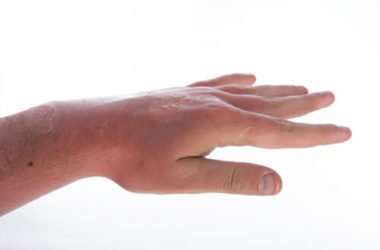 Quali sono i migliori rimedi naturali per le bruciature e le piccole ustioni?