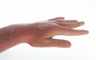 Quali sono i migliori rimedi naturali per le bruciature e le piccole ustioni?