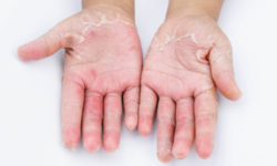 Disidrosi, cos’è e come si manifesta questo eczema e quali sono i rimedi naturali