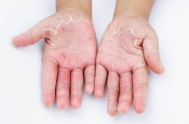 Disidrosi, cos’è e come si manifesta questo eczema e quali sono i rimedi naturali