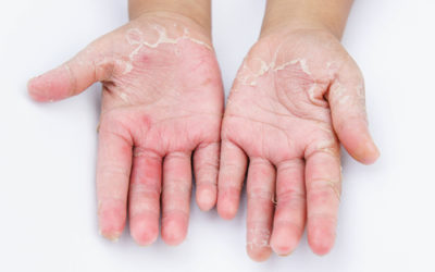 Disidrosi, cos’è e come si manifesta questo eczema e quali sono i rimedi naturali