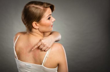 Orticaria: come curarla e prevenirla in modo naturale