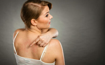 Orticaria: come curarla e prevenirla in modo naturale